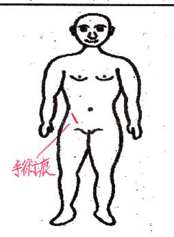 画像:手術痕
